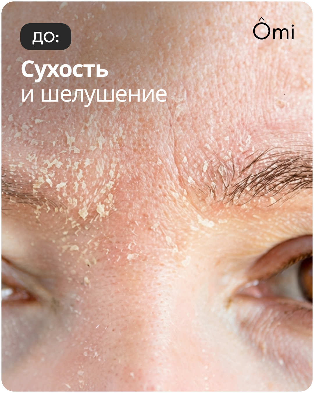До: сухость и шелушение