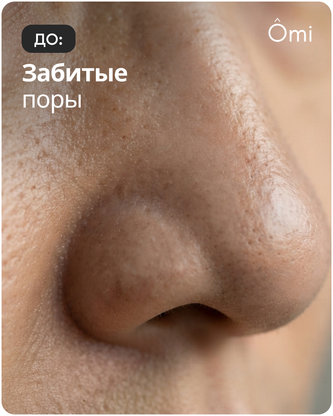 До: забитые поры