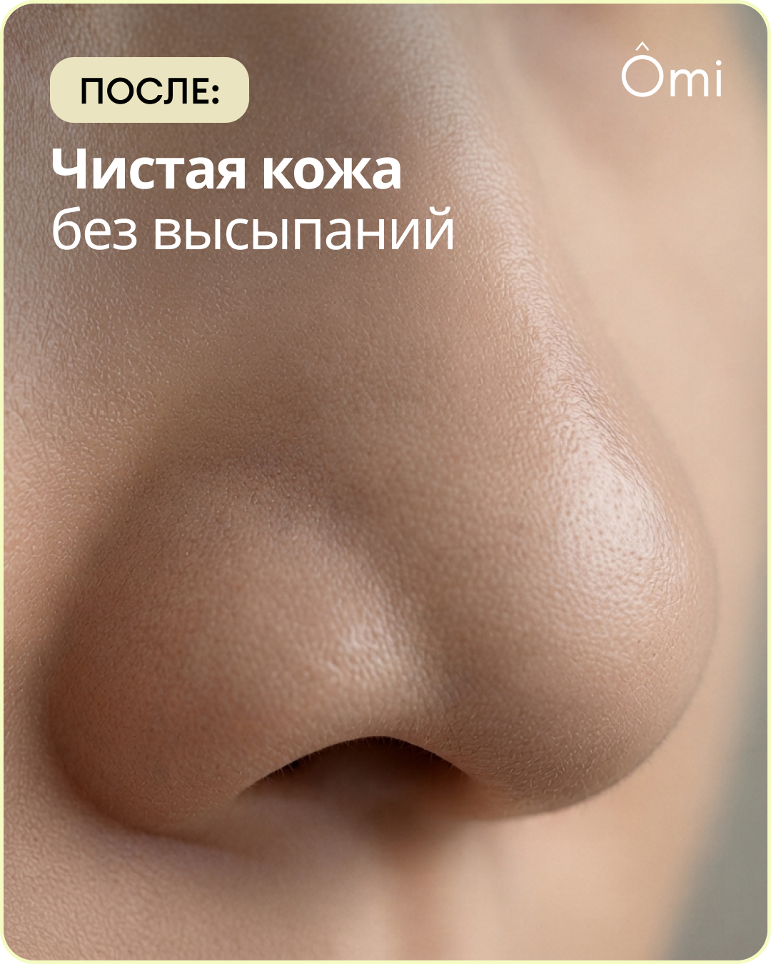 После: чистая кожа без высыпаний